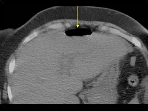CT image showing air in the peritoneal cavity anterior of the liver. There is no air in the intrahepatic bile ducts.