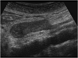 Longitidinal image of an abnormal superior mesenteric vein anterior of the aorta filled with a hypo-echoic intraluminal mass.