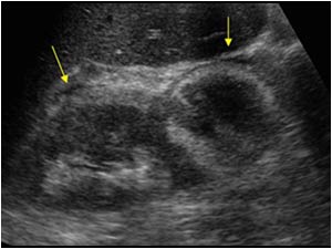 Longitudinal image of the right kidney with an inhomogeneous mass in the lowerpole of the kidney with a hyperechoic rim and a perirenal effusion