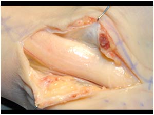 Longitudinal image of the thickened nerve made during operation.