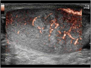 Longitudinal image with e-flow of the enlarged right testis with irregular vascularity in the testicular mass