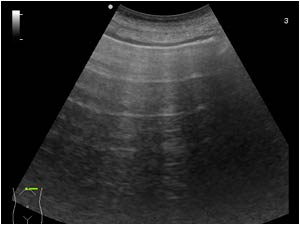 Dilatated colon with air mimicking free peritoneal air transverse