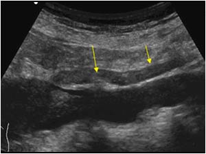 Tumor thrombus in the right ovarian vein longitudinal