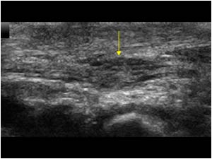 Localized thickening of the nerve longitudinal