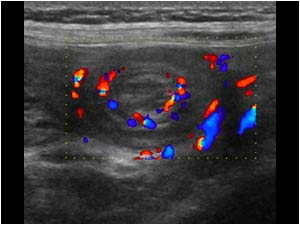 Color Doppler shows normal vascularization of the bowel walls in the intussusception