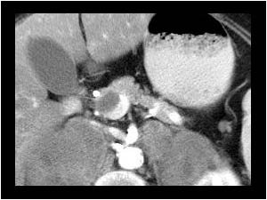 Thrombus in the portal confluence CT
