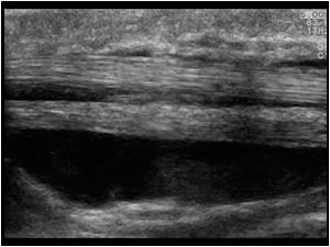 Tenosynovitis of the flexor tendons longitudinal
