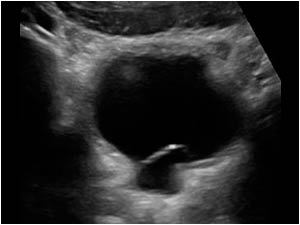Small ureterocele like cystic structure at the site of the left ureteric orifice