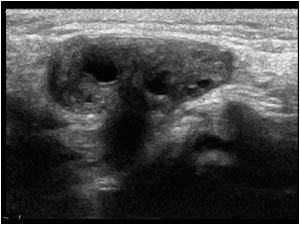 Inguinal hernia with ovary
