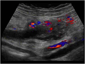 Flow in the wall of the ovarian vein but not in the lumen