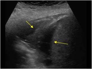 Subphrenic abscess and atelectasis of the lower lobe