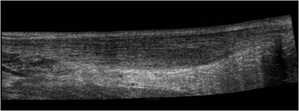 Diffuse tendinosis of the achilles tendon longitudinal