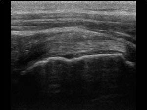 Medially displaced biceps tendon in the subscapularis longitudinal