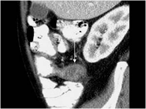 Sagittal CT image of the appendix with similar findings.