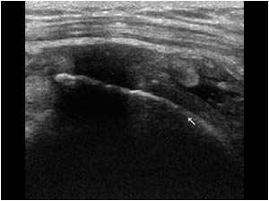 Supraspinatus tendon rupture and bursa with synovial proliferations transverse
