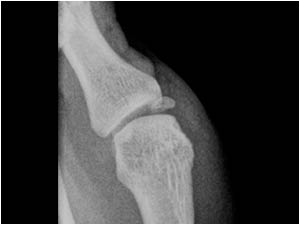 Traumatic lesions of the radial collateral ligament of the thumb