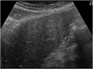 Longitudinal image of the left liver lobe of patient 2 showing a hyperechoic liver with an irregular contour.