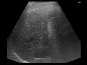 Longitudinal image of the right liver lobe of patient 1 showing the same features.
Both patients have a cirrhotic liver.