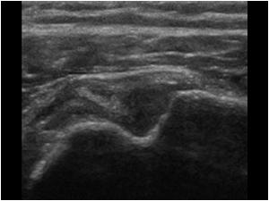 Absent tendon in the bicipital groove transverse
