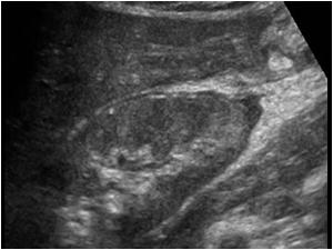 Longitudinal image of the right kidney with a small amount of perirenal fluid