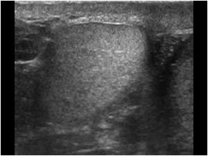 Transverse image of the structure next to the right testis