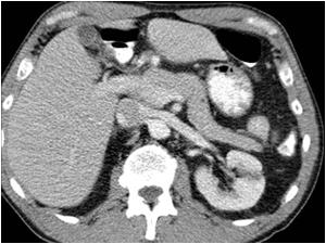 CT image of the normal pancreas 