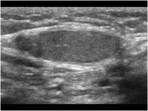 Longitudinal image of a normal right testis in a 2 year old boy. The left testis was not palpable