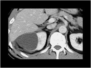 Traumatic rupture of a large renal cyst with pericystic fluid and irregular cyst wall