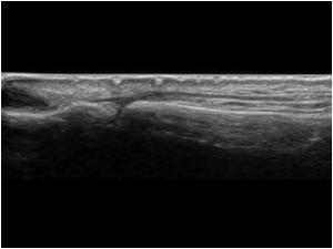 Dorsal aspect Extensor pollicis longus tendon at the IP joint longitudinal