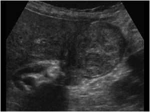 There is an abnormal gallbladder filled with echogenic material sludge or tumor?