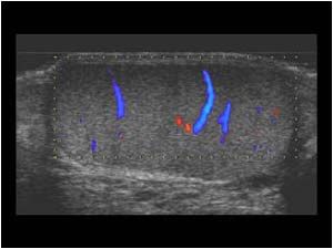 Normal flow in the right testicle