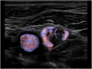 Transverse color doppler image of the mass showing that the mass is vascularized