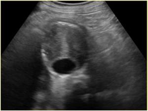 Transvere image of the aneurysm.
The patient died immediately after the ultrasound examination