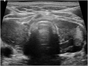 Transverse image of a diffusely abnormal thyroid gland