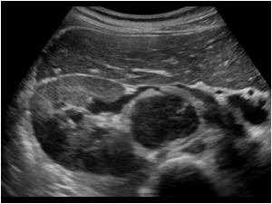 Transverse image of the right kidney with hypoechoic lesions