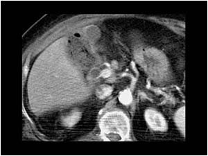 Abscess filled with pus and air CT