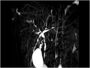 MRI image of the same patient showing caliber changes in the intra and extra hepatic bile ducts