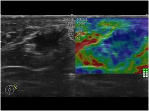 The lesion is moderately stiff with elastography so that doesn't really help. The patient was treated for FAP and we did a core biopsy