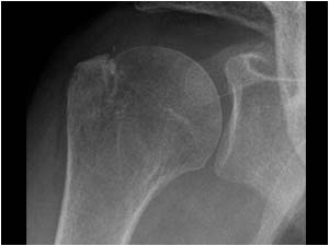 Greater tuberosity fracture