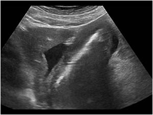 There is a diffuse thickening of the stomach wall. The differentiation of the layers of the wall is gone. There is some ascites