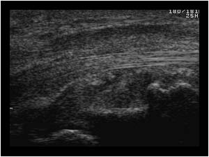 Synovial thickening and small calcifications in the carpal tunnel longitudinal