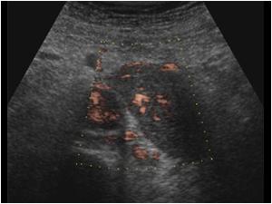 There are vessels visible in the mass in the renal vein