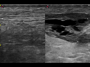 Case: Severe partial tear Achilles tendon