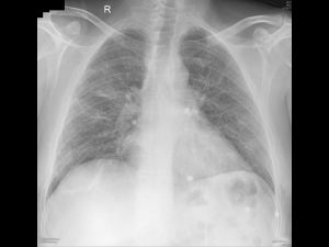 Case: COVID-19 Pneumonia