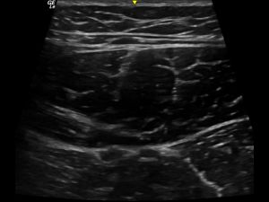 Rectus femoris muscle transverse other side normal