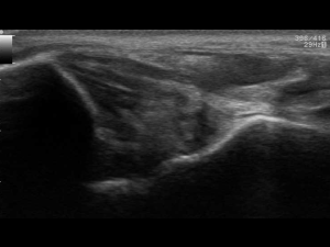 Longitudinal ultrasound  of a thickened torn posterior tibiotalar ligament