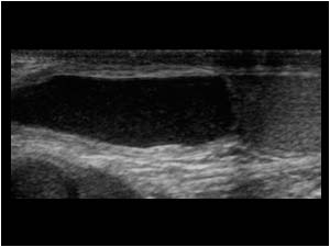 Cystic mass in the tunica vaginalis