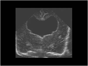 Coronal single midline ventricle