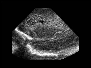 Sagittal periventricular leucomalacia with cysts