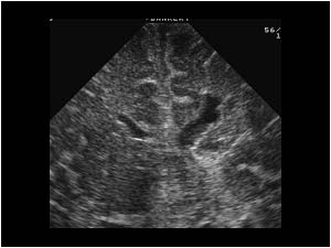 Coronal cystic spaces confluating with the lateral ventricle